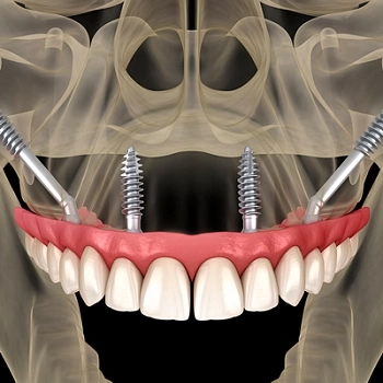 Скуловые импланты Zygoma 